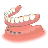 インプラント義歯